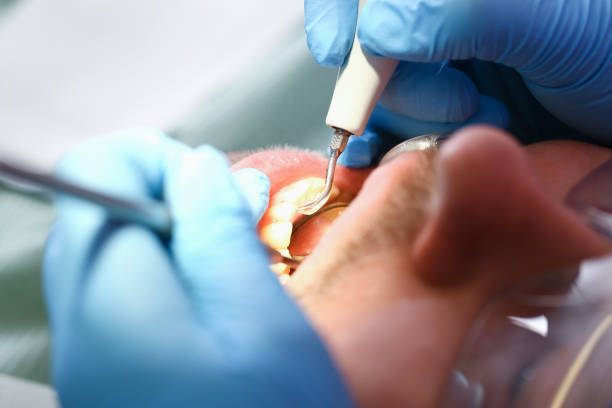 Best Emergency Tooth Extraction in Shady Hills, FL